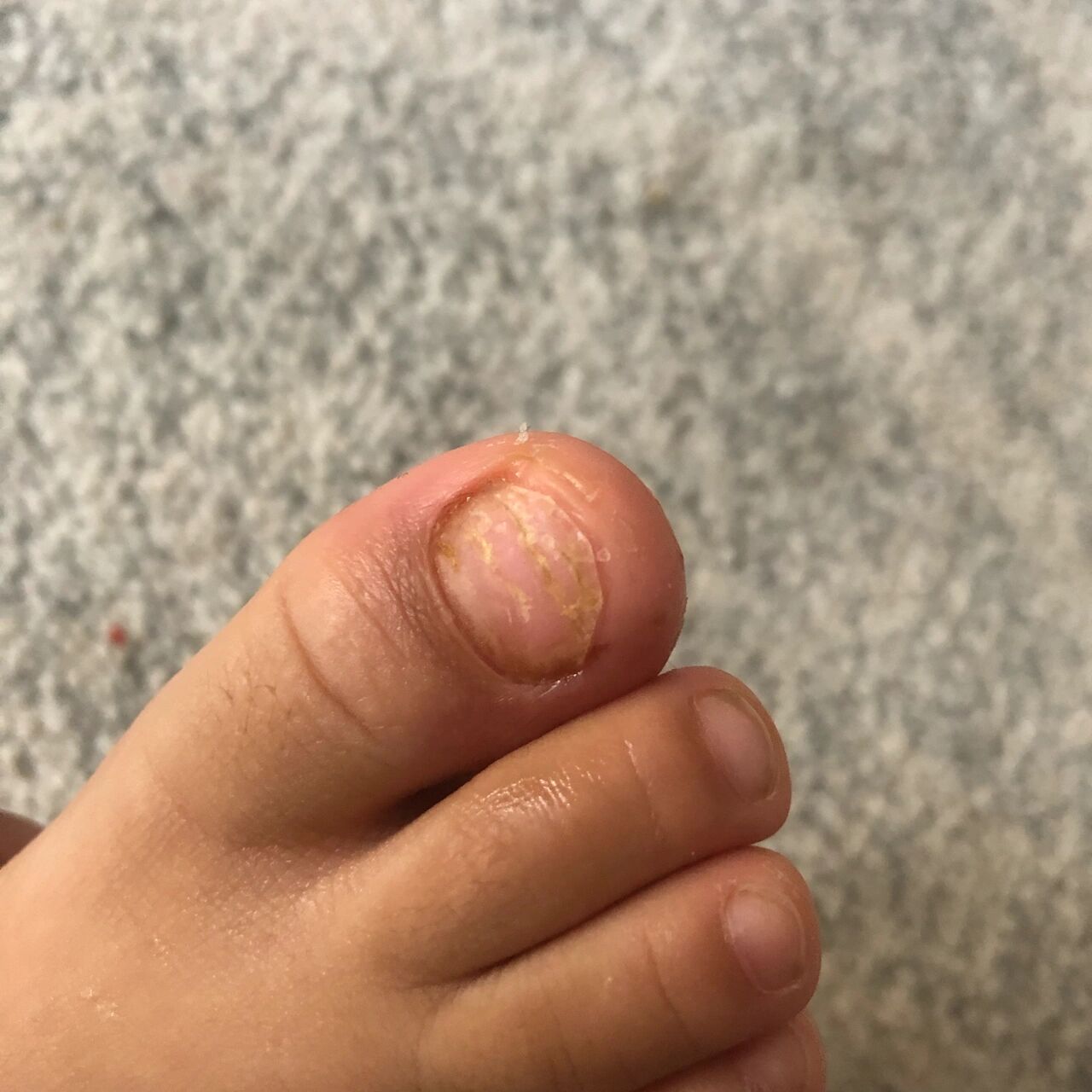 三岁宝宝竟然得了灰指甲