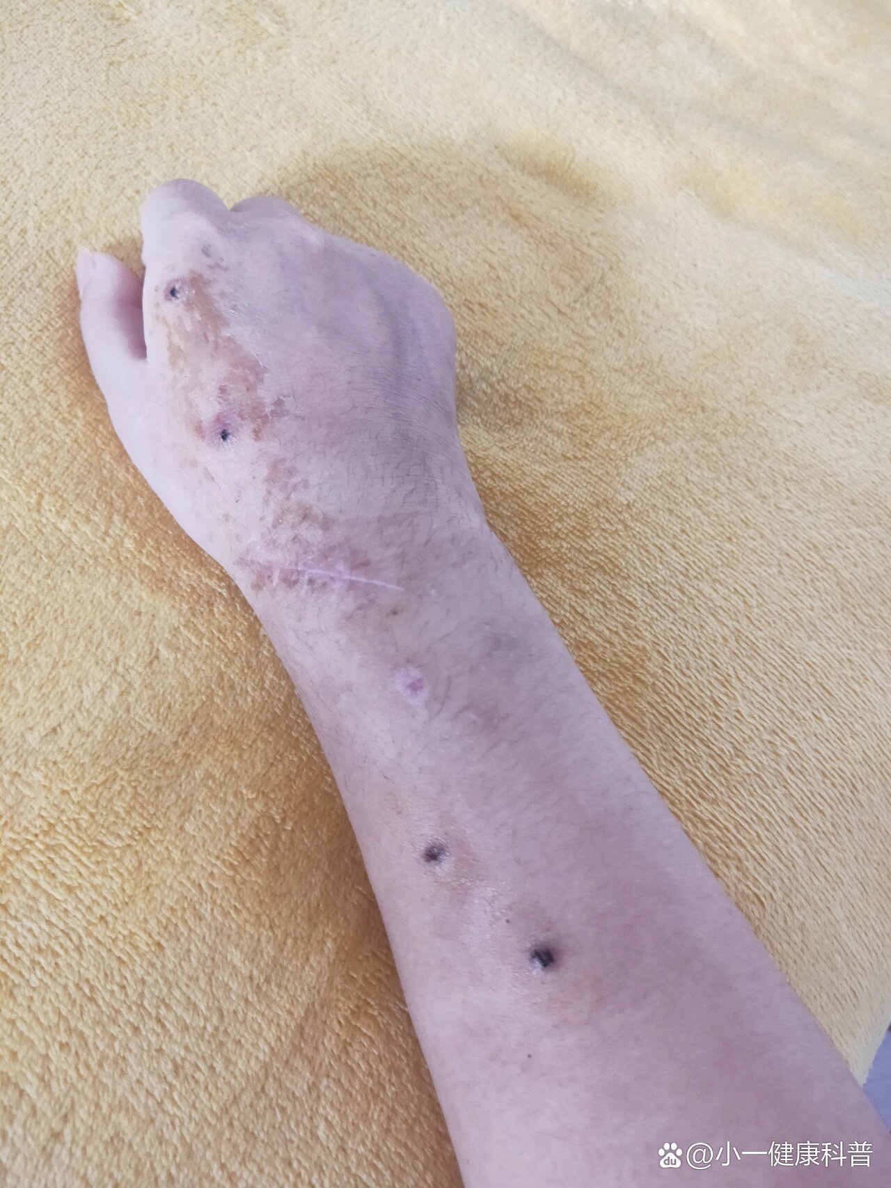 拆支架的第三天,伤口都愈合了