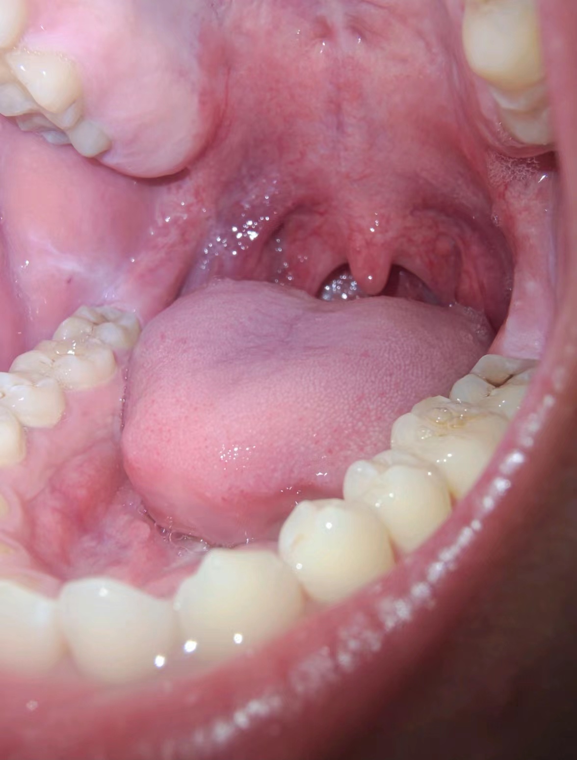 Infectie van Ulcus binnenkant mond — Stockfoto © mrfiza #131148334