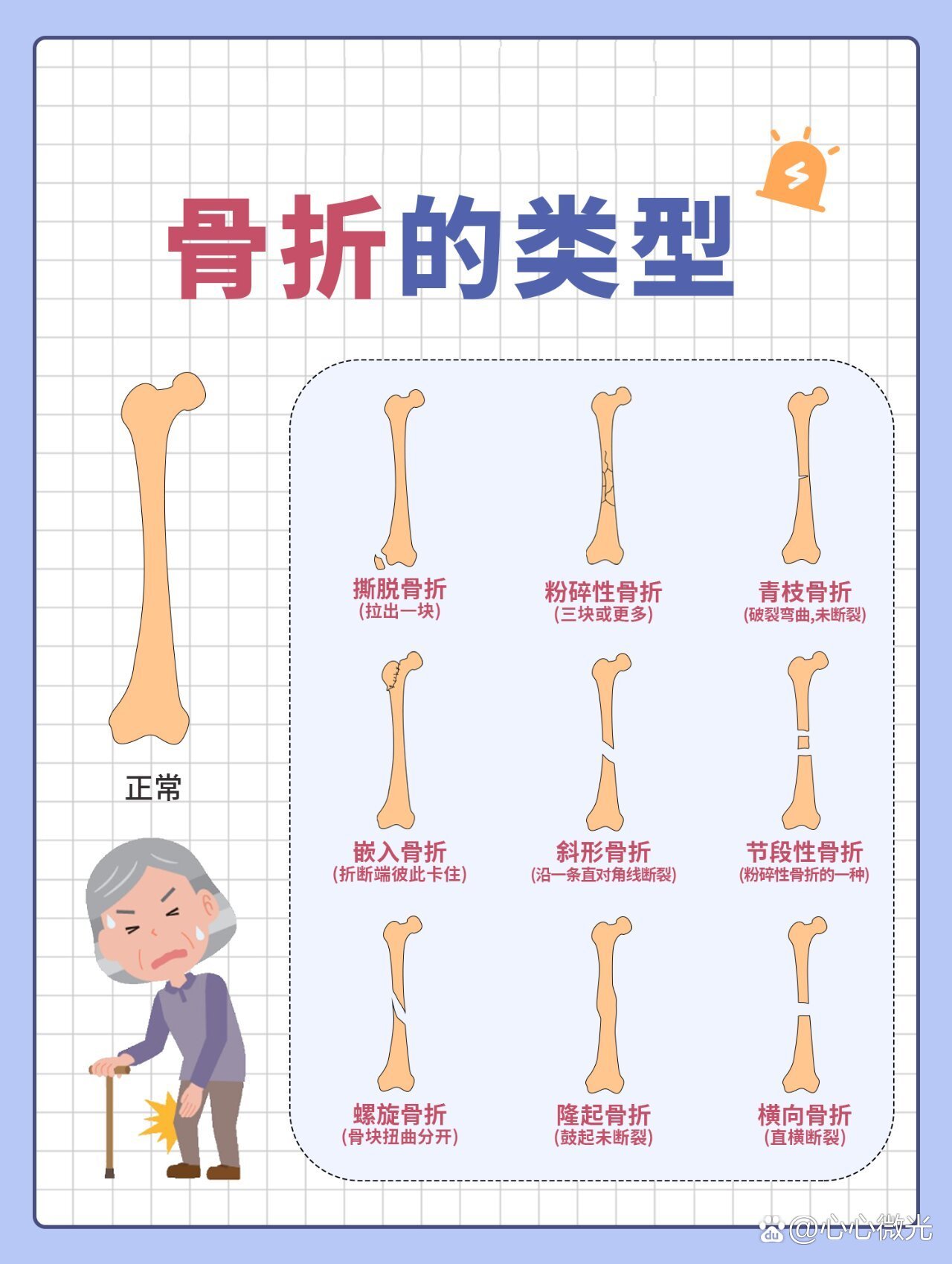 骨折愈合过程 示意图图片