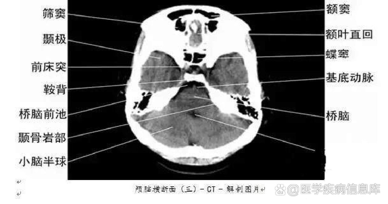 环状软骨ct解剖图图片