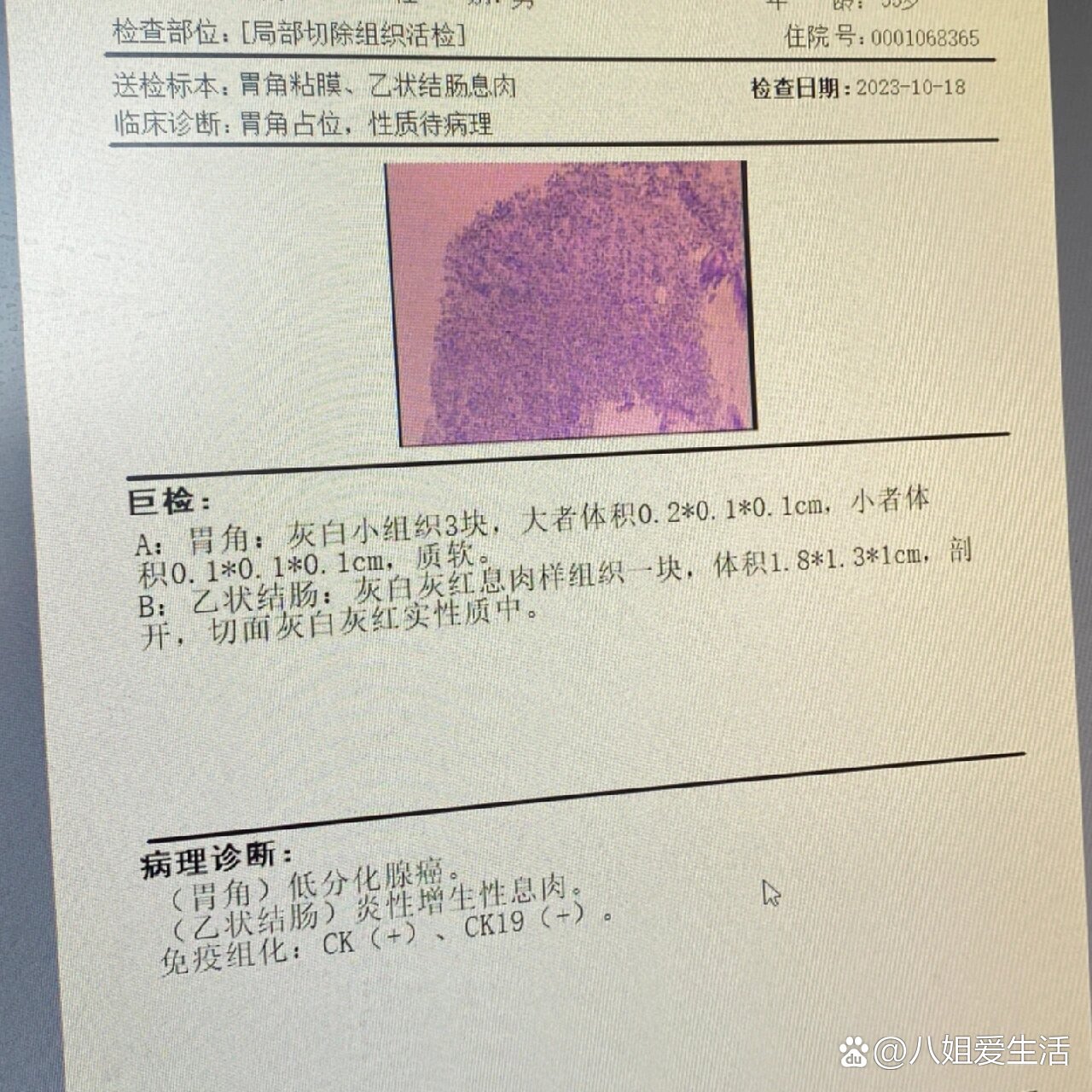 胃癌化验单图片