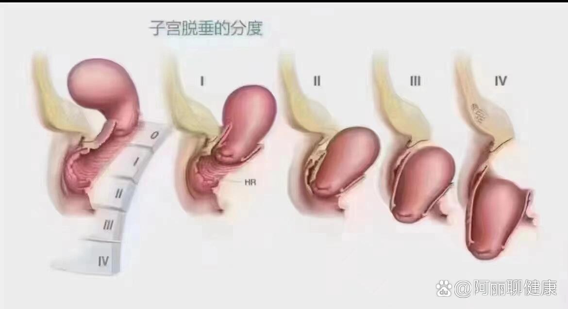 99子宫脱垂6015