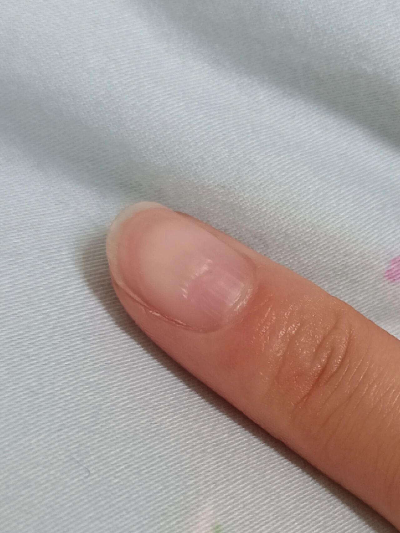 指甲上面有横沟是怎么回事呀