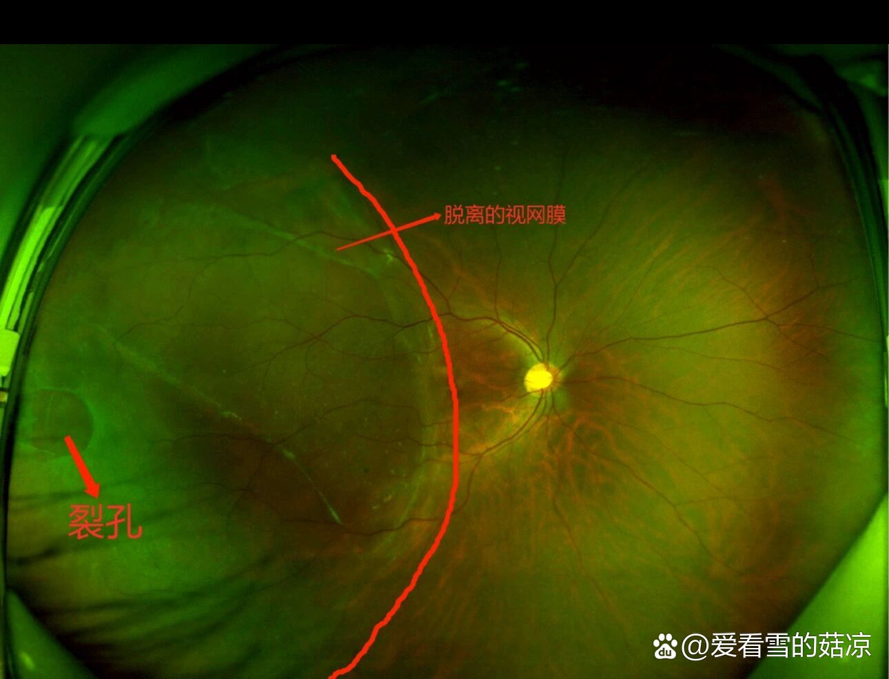 科普:   高度近视引发的眼底病变相信有的小伙伴们去医院检查