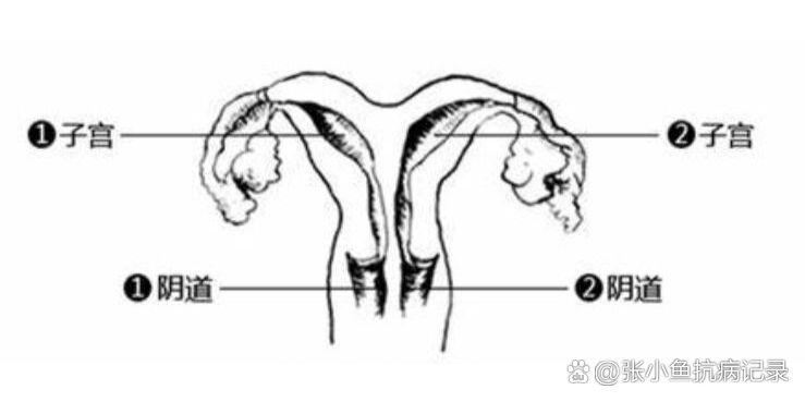 子宫纵隔纵隔子宫图片