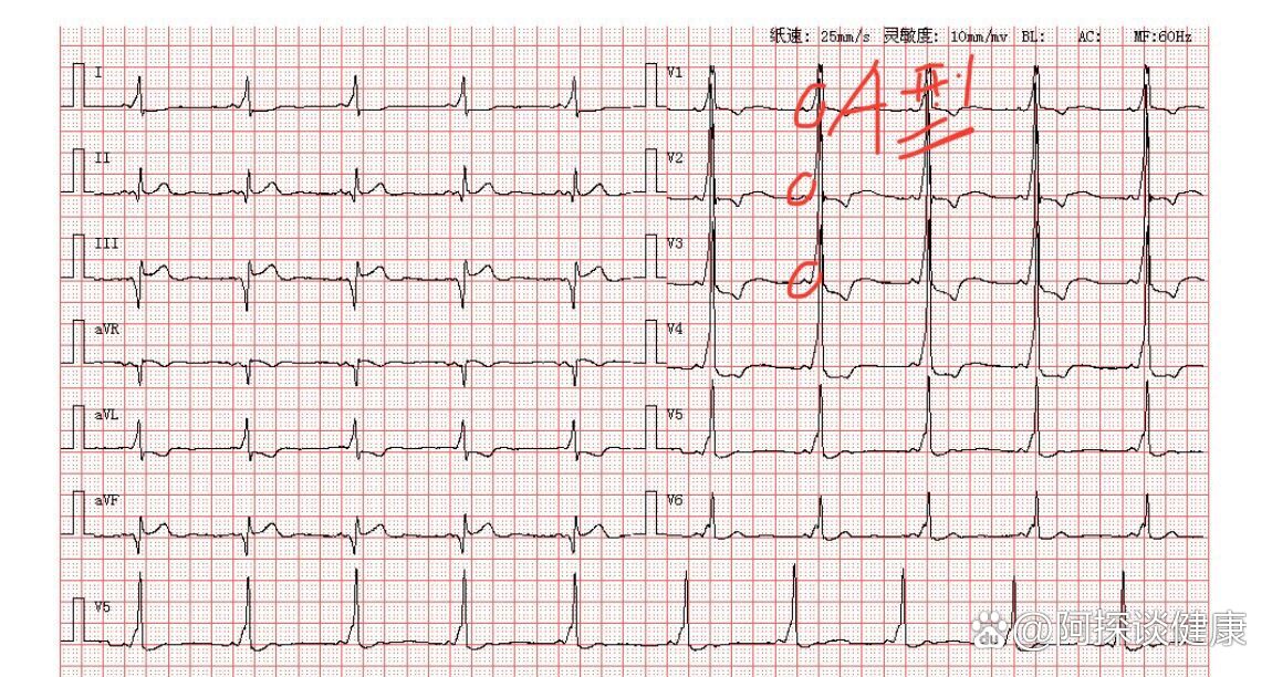 心电图:急性心梗,a型预激波