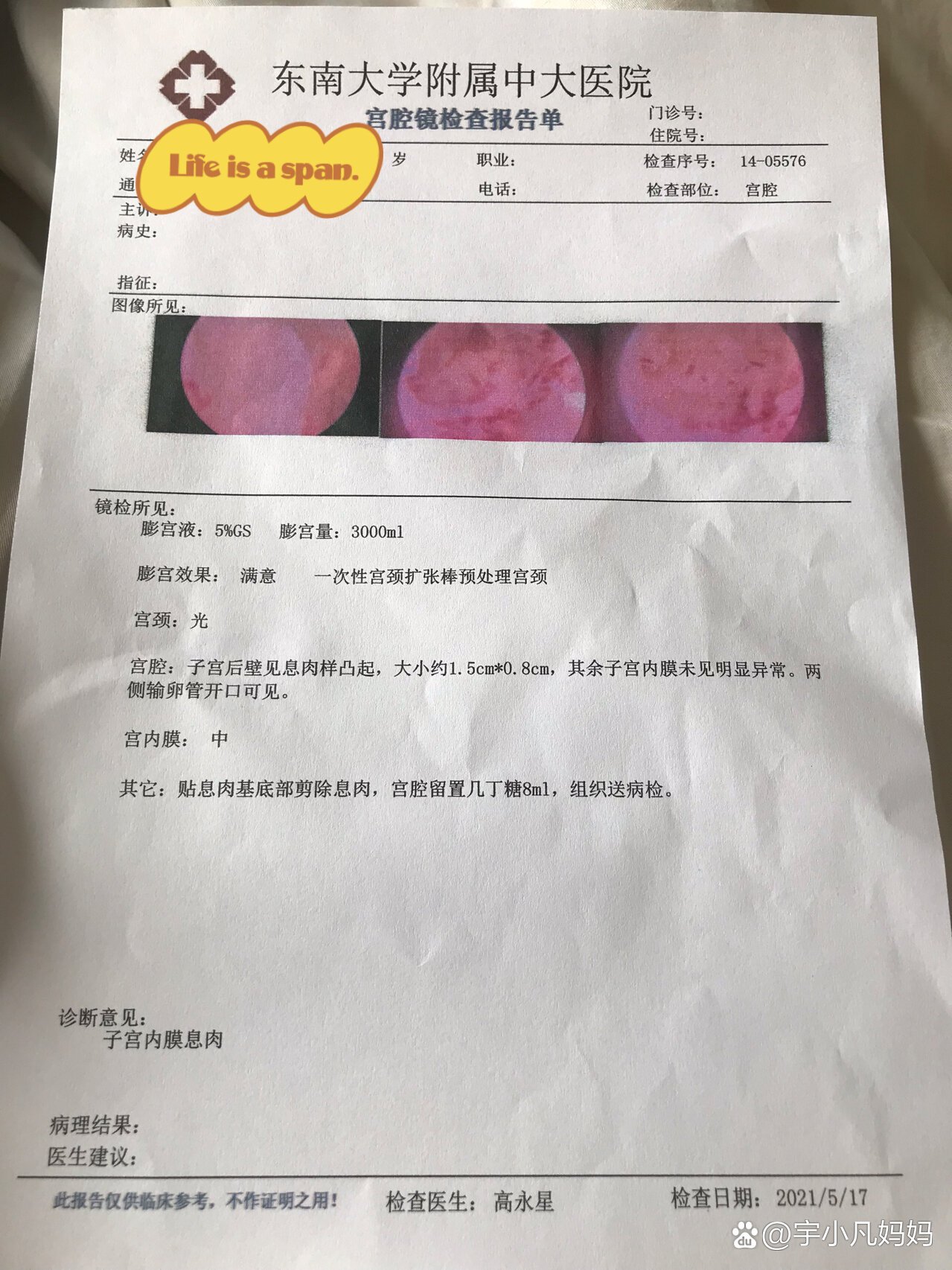 子宫内膜息肉宫腔镜手术当日小记