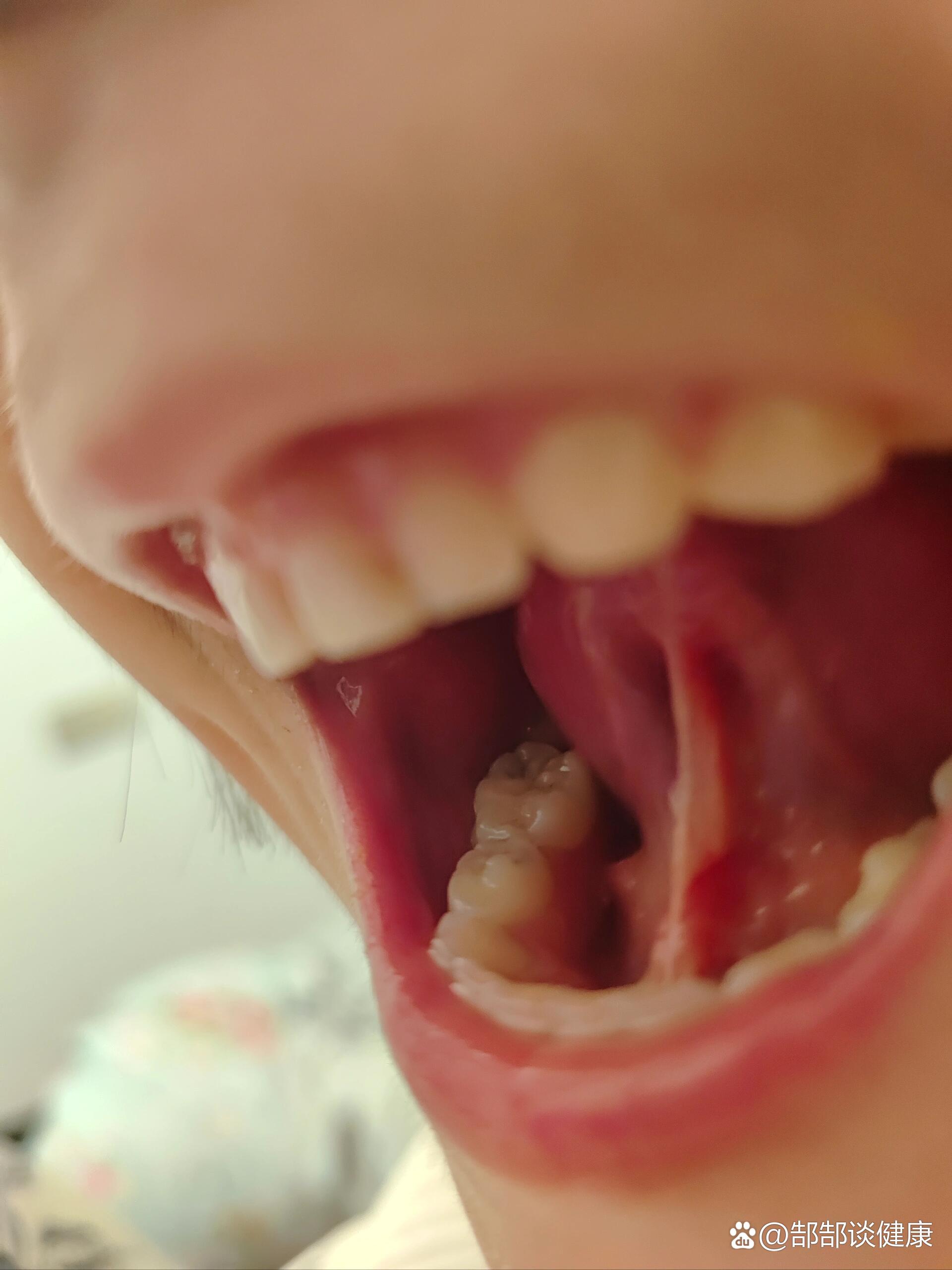 舌系带需要剪吗?