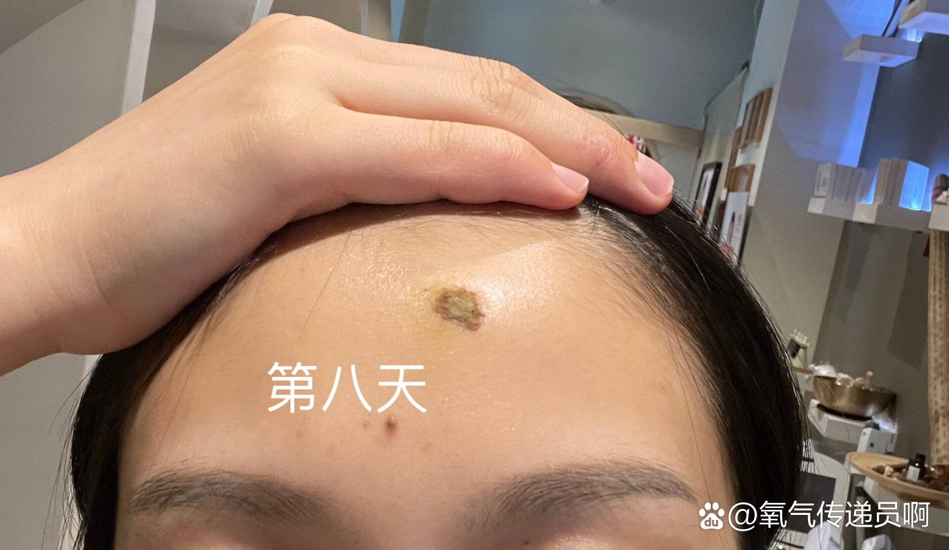 水痘坑修复第八天
