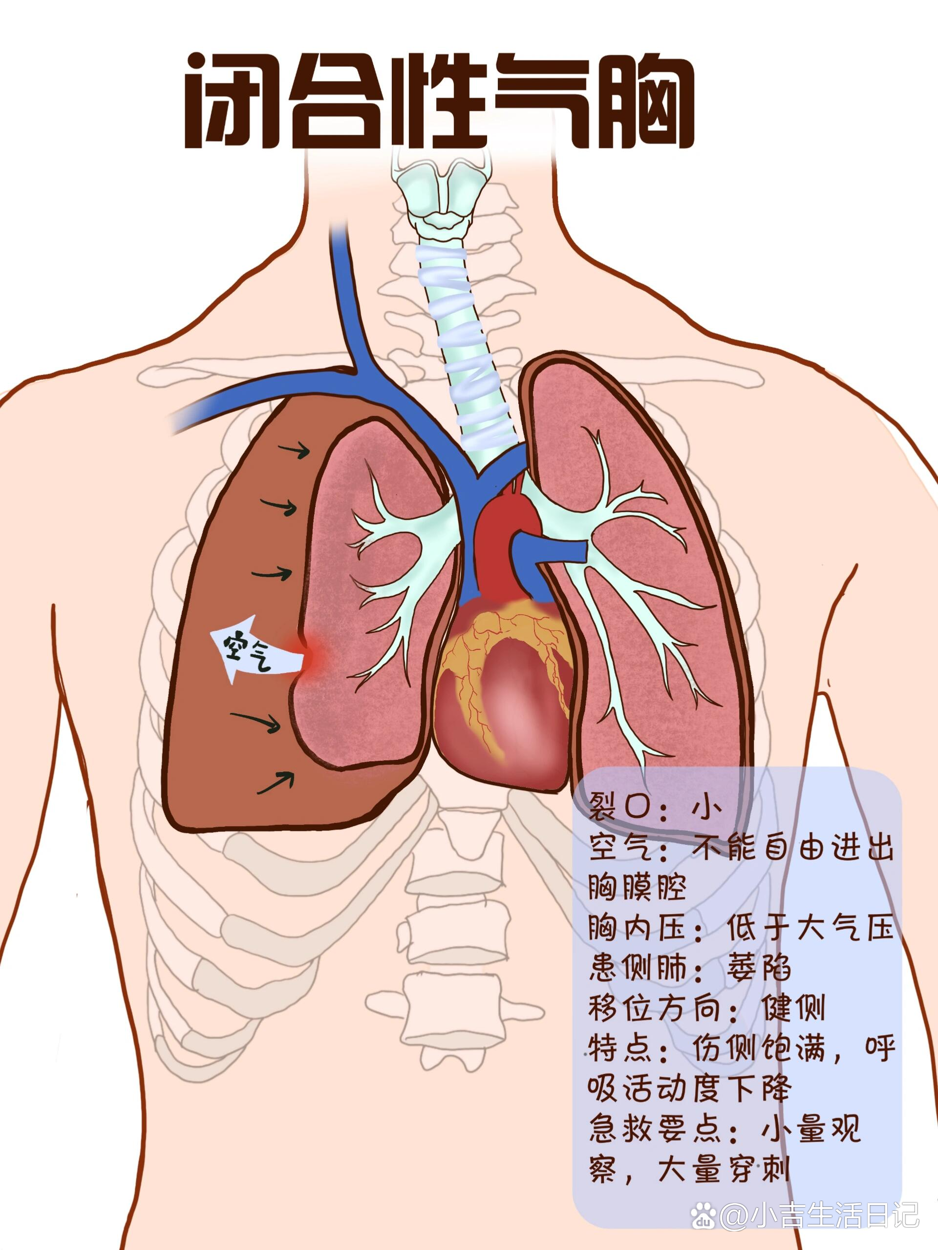 气胸线怎么看图片