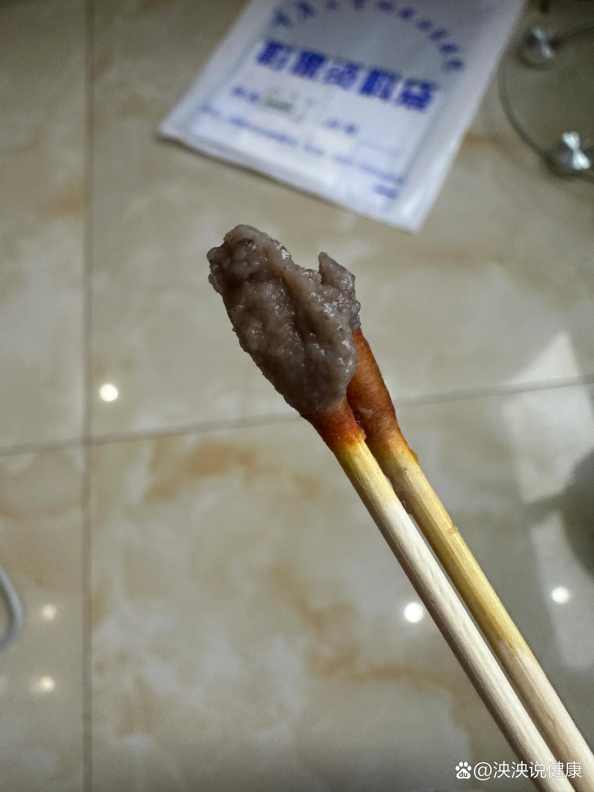 前庭大腺脓肿造口术后