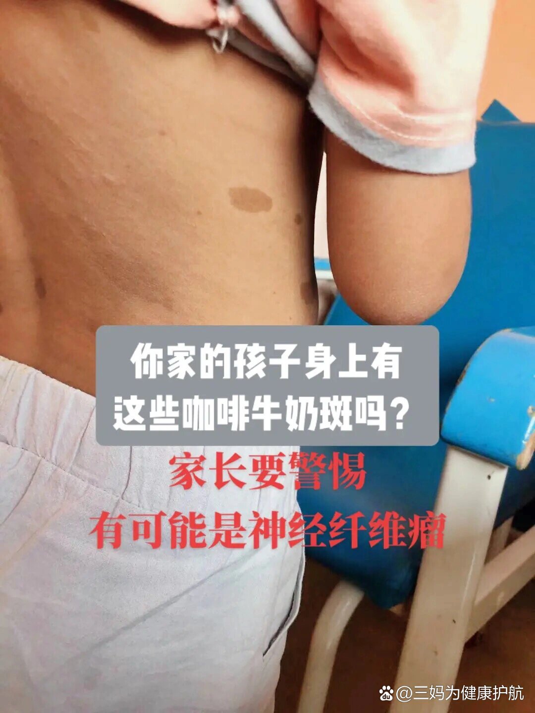 p 你家的孩子身上有这些咖啡牛奶斑吗? br 这可不是胎记哦