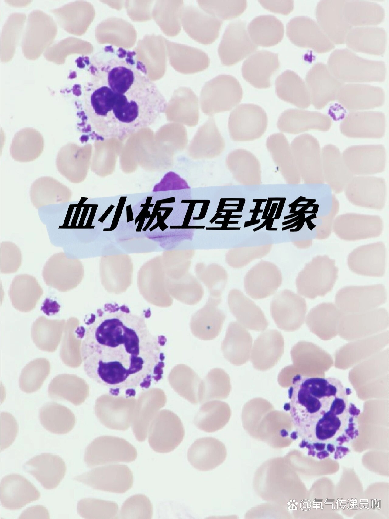 血小板卫星现象