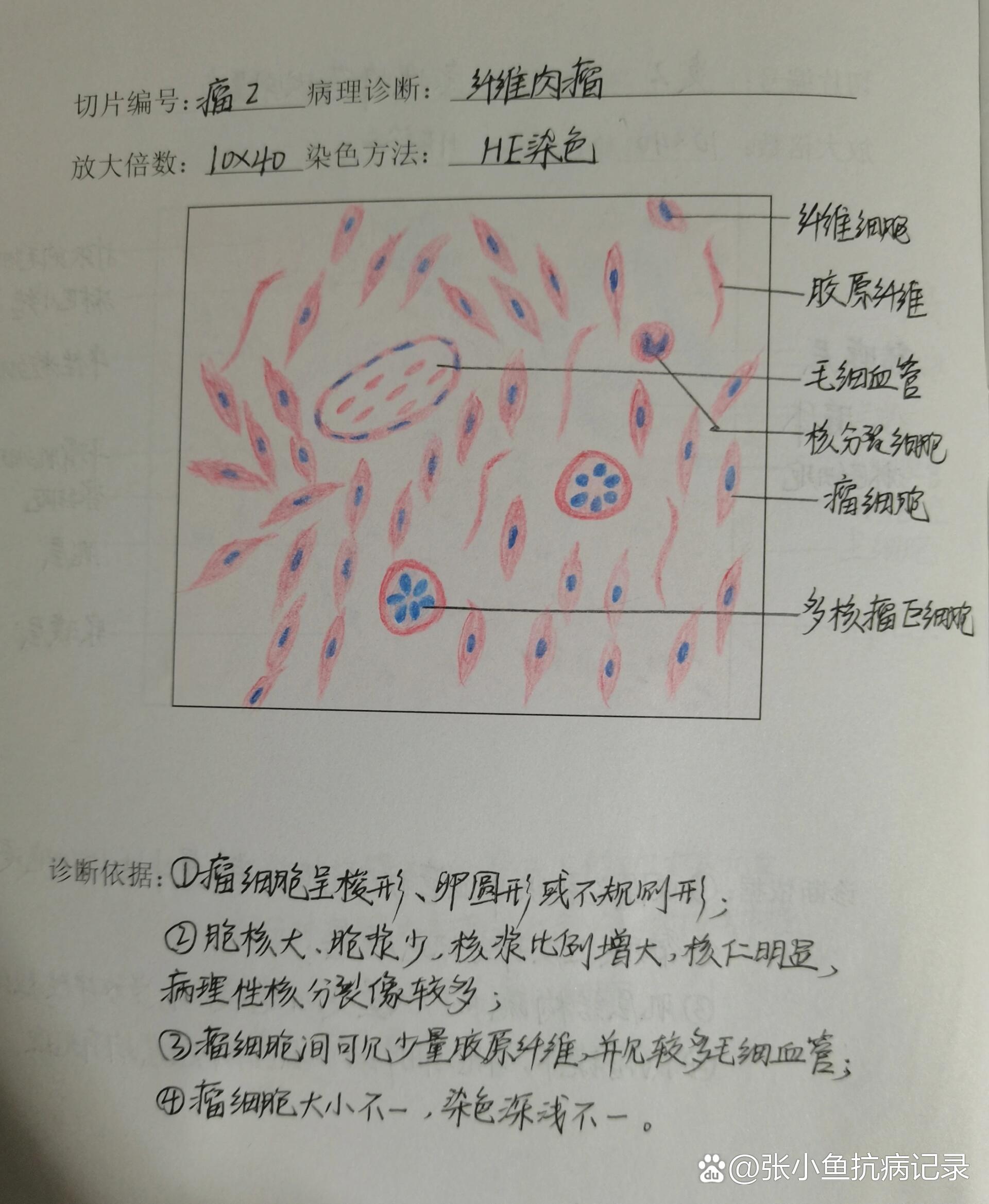 绒毛膜癌病理手绘图图片