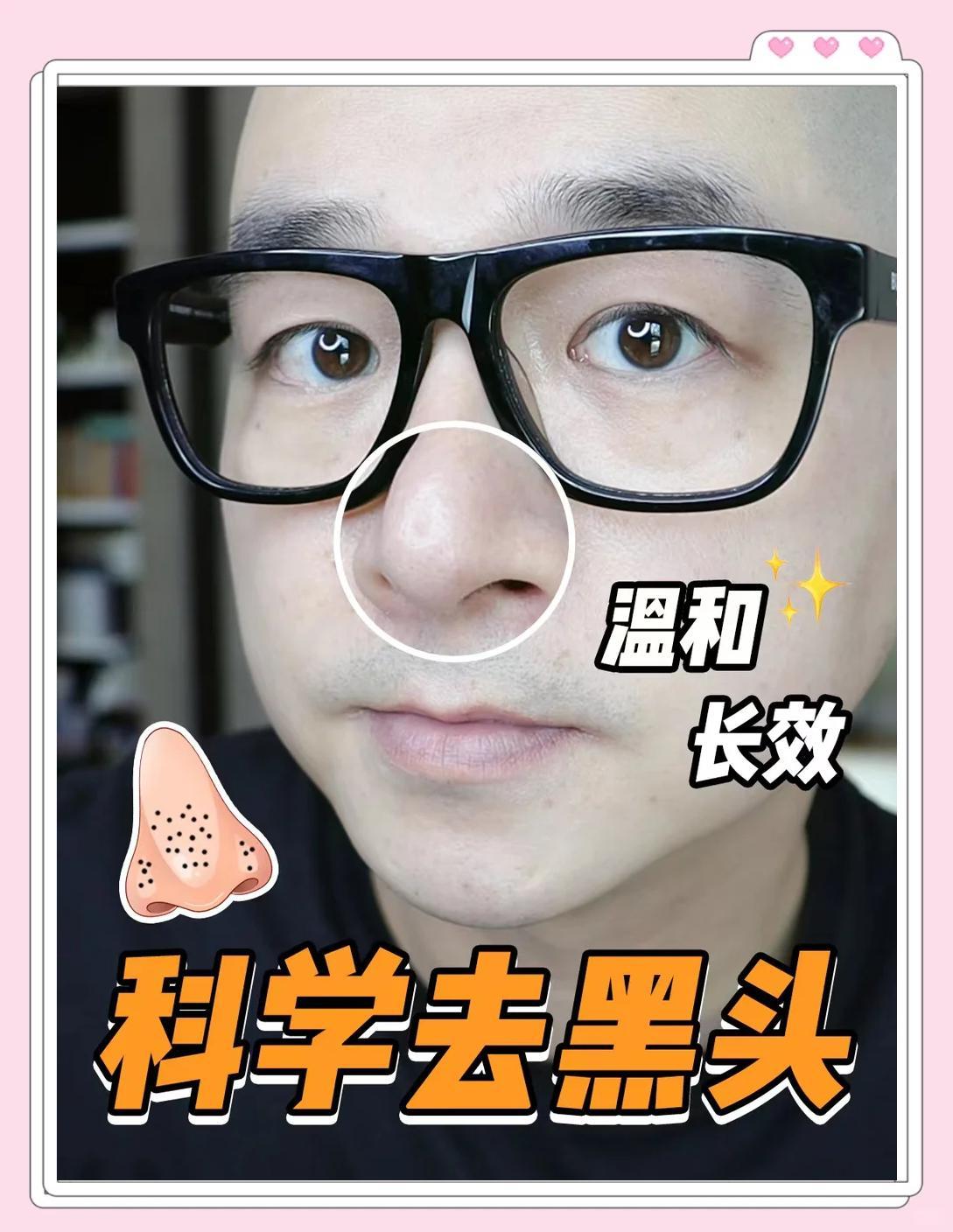 黑头终结者：温和去黑头的三步秘诀