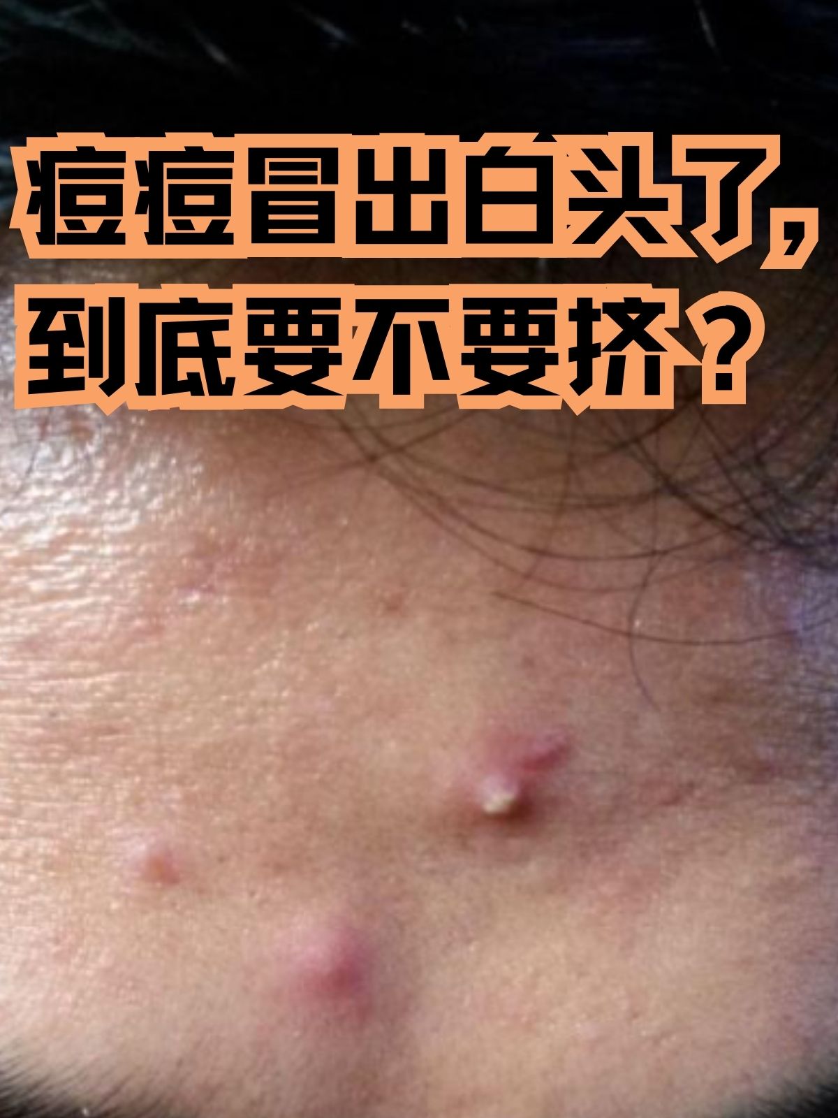 痘痘冒出白头了,到底要不要挤?