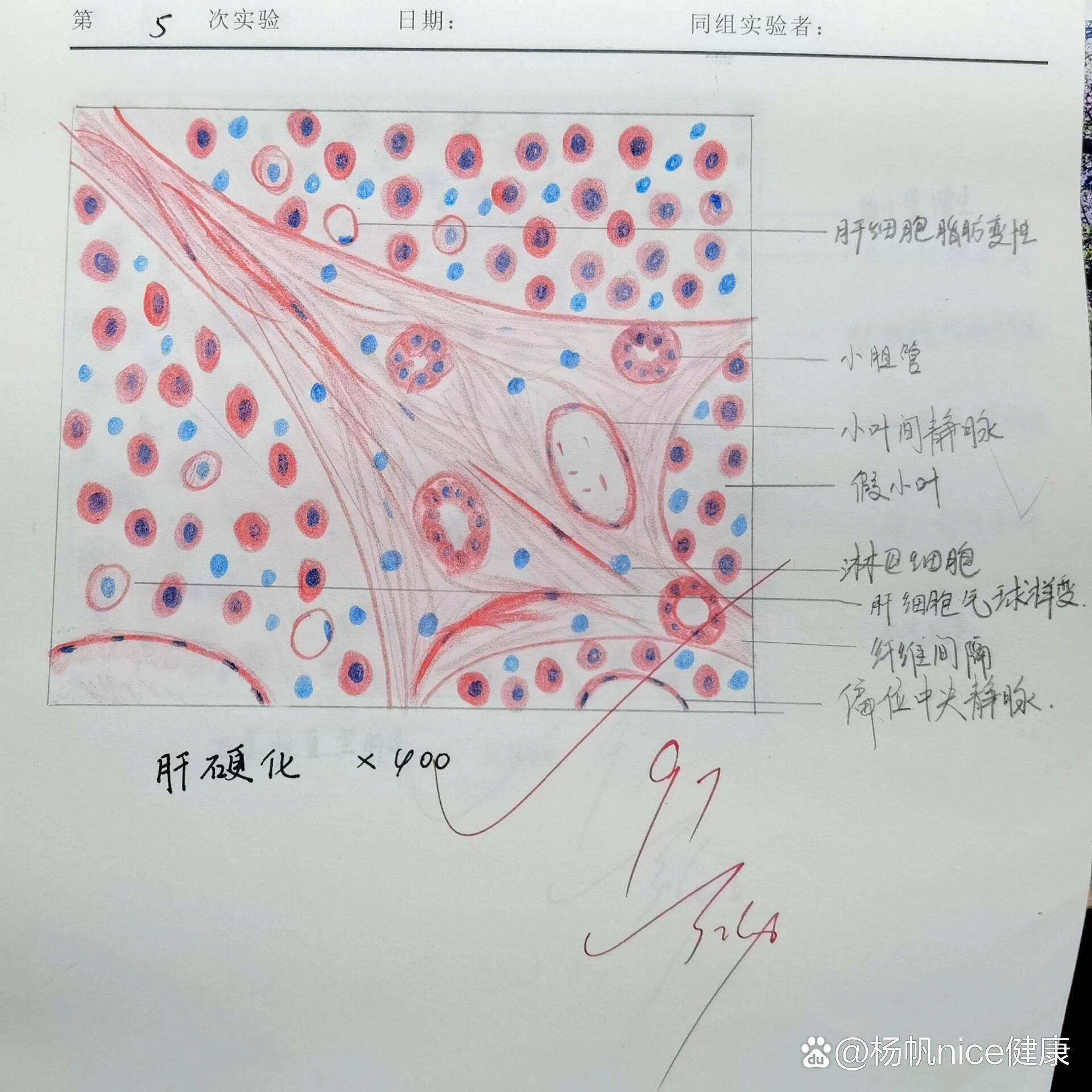 绘制肝硬化镜下红蓝图图片