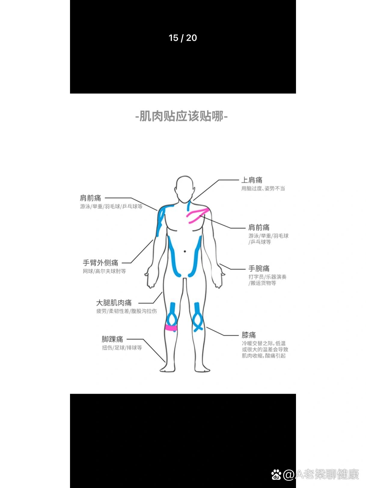 膝盖脂肪垫图片图解图片