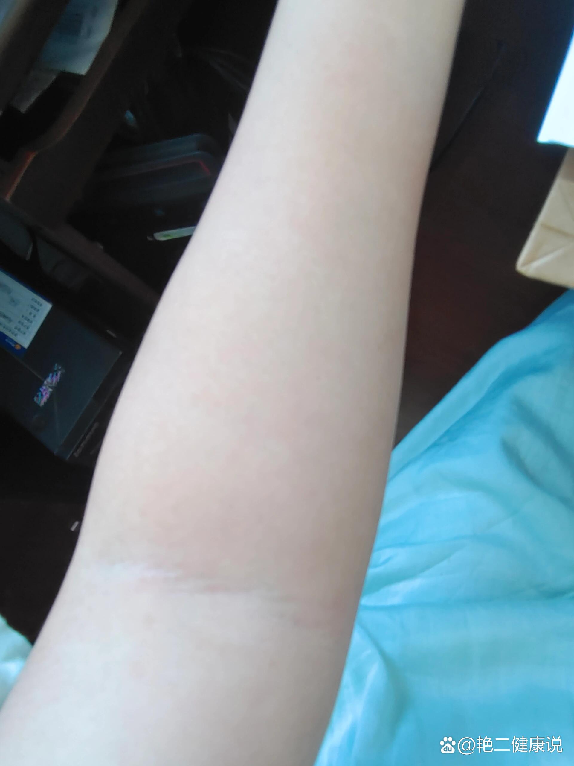 原来扎针会让血管越来越细