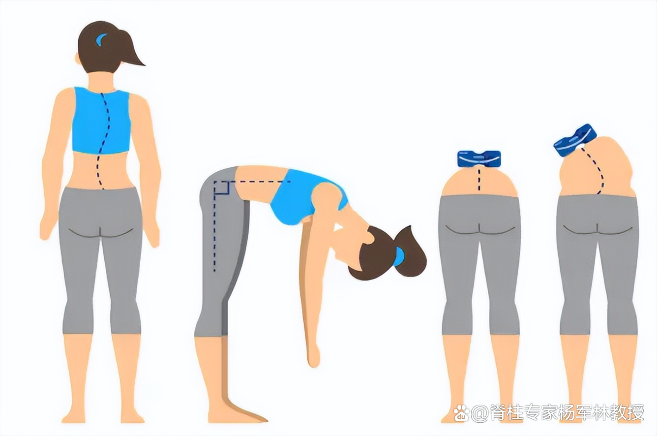 破坏美感的"剃刀背",可能是脊柱侧弯引起的!