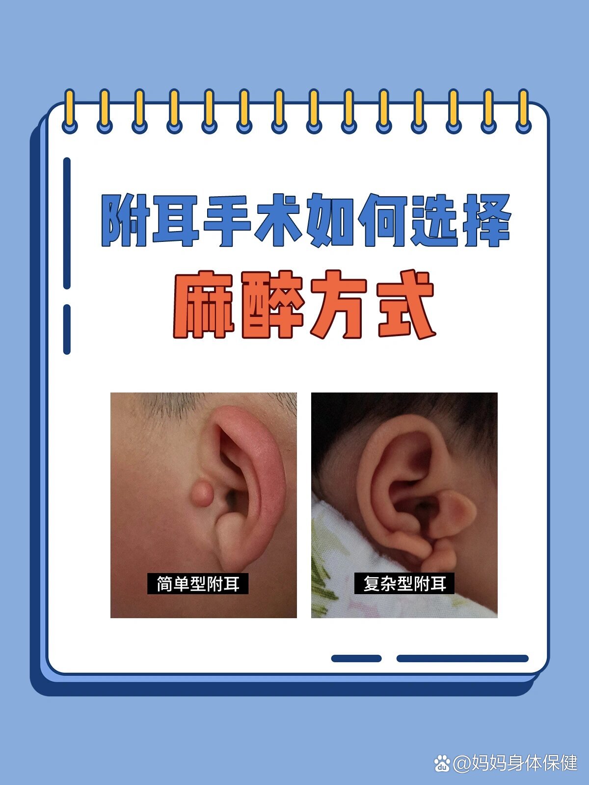 小儿附耳手术如何选择麻醉方式