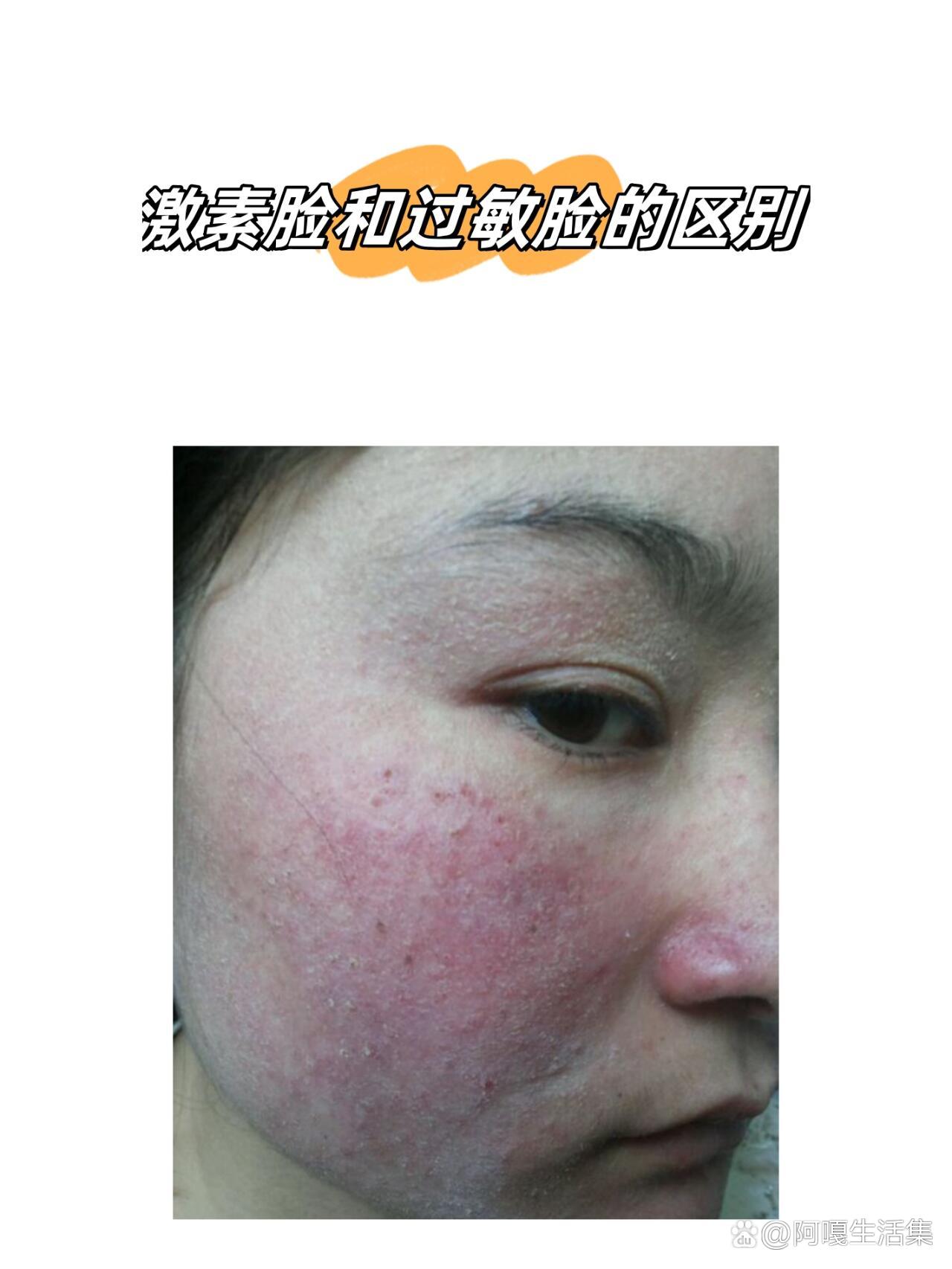 激素脸和过敏脸在多个方面存在明显的区别