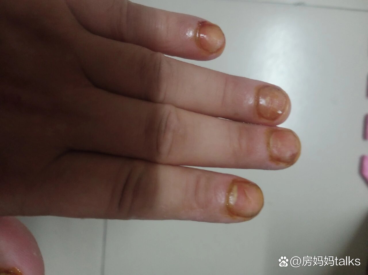 治疗灰指甲第三天