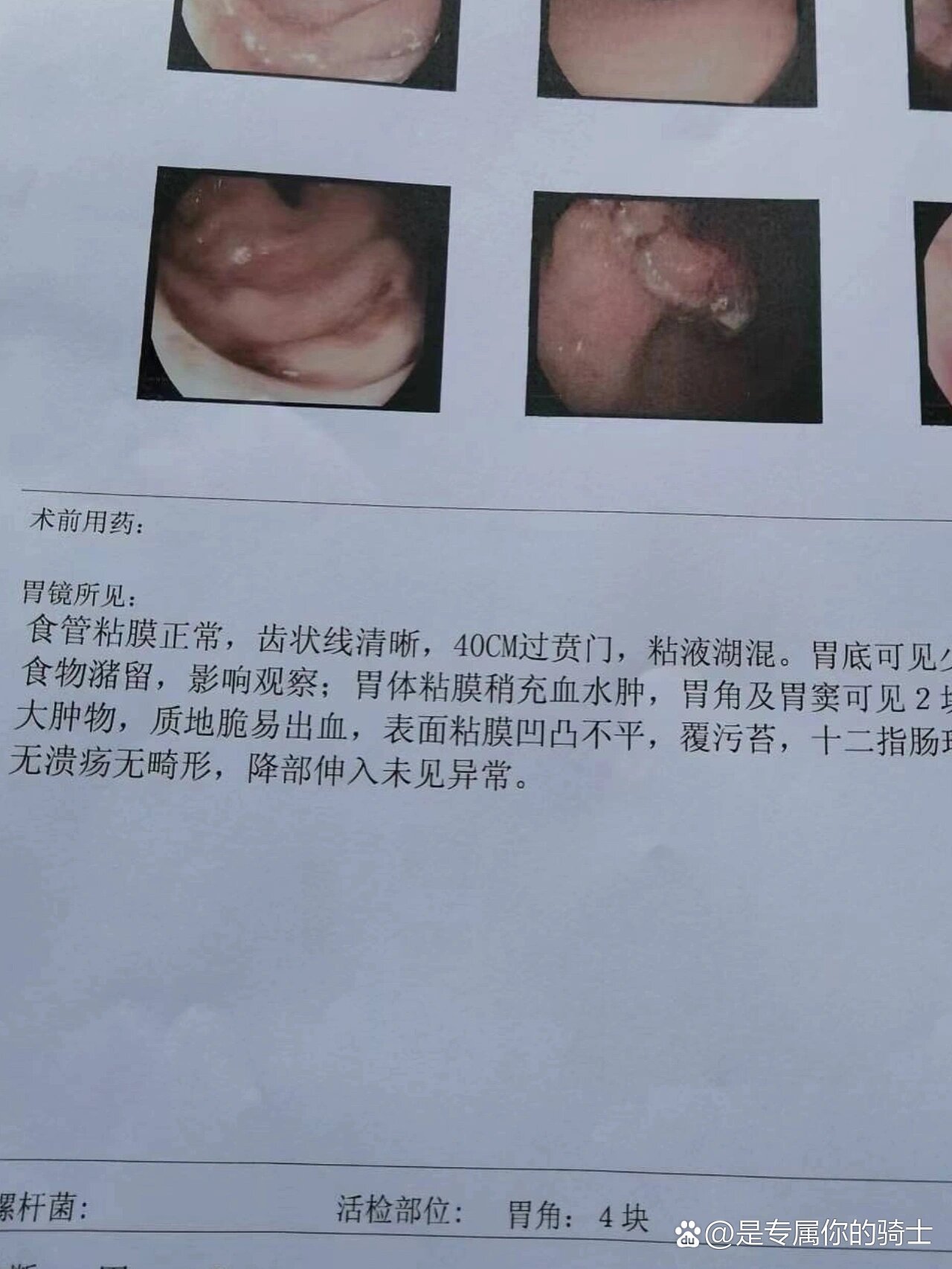 爸爸昨天突然呕血了今天胃镜考虑胃癌成为了癌症患者家属最不想的