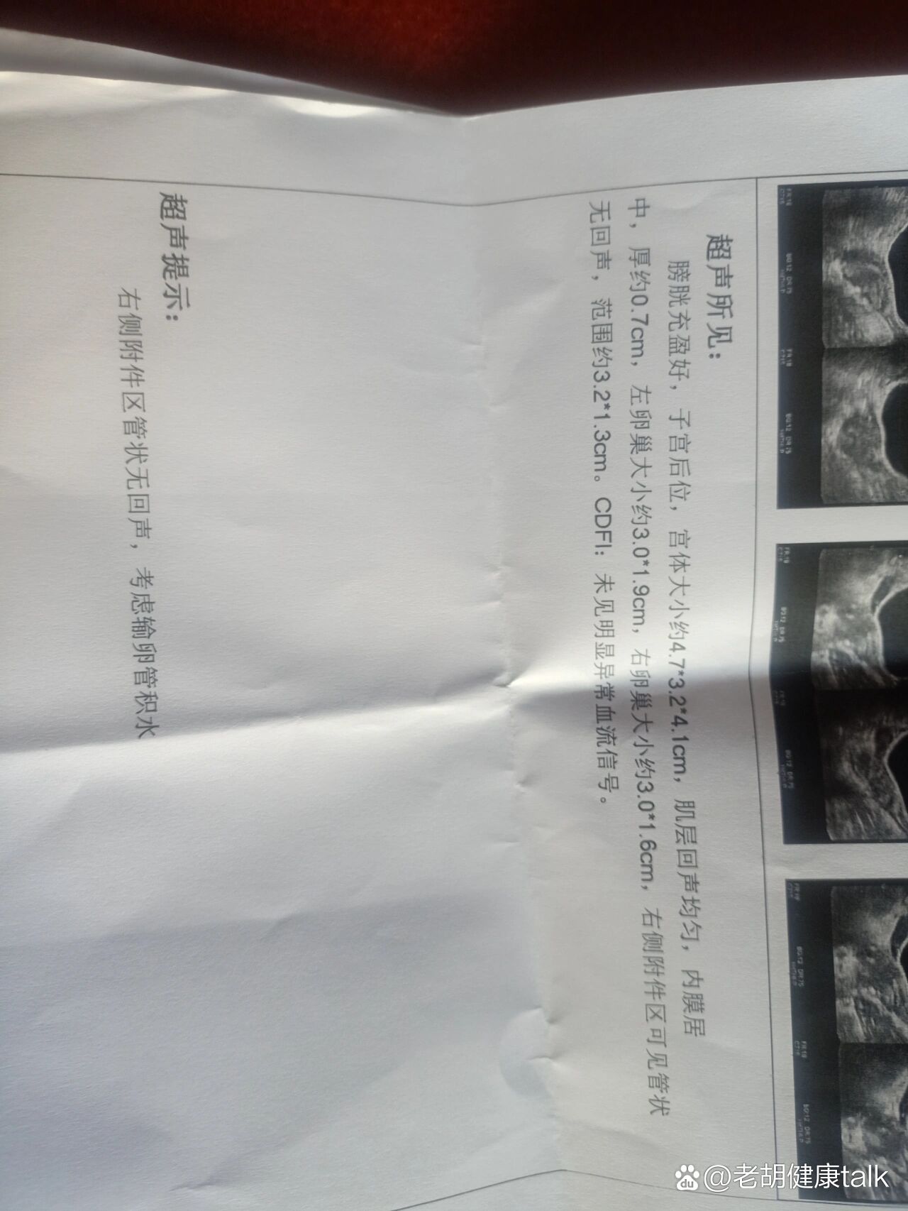 右侧附件区囊性包块