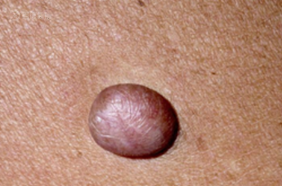 中年人患有弹力纤维瘤,需要进行手术治疗