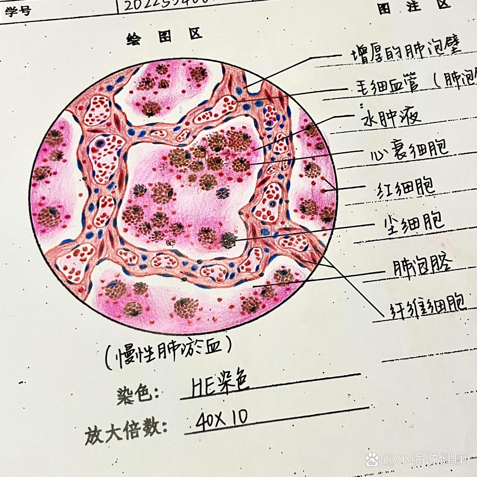 慢性肺淤血镜下实验图图片