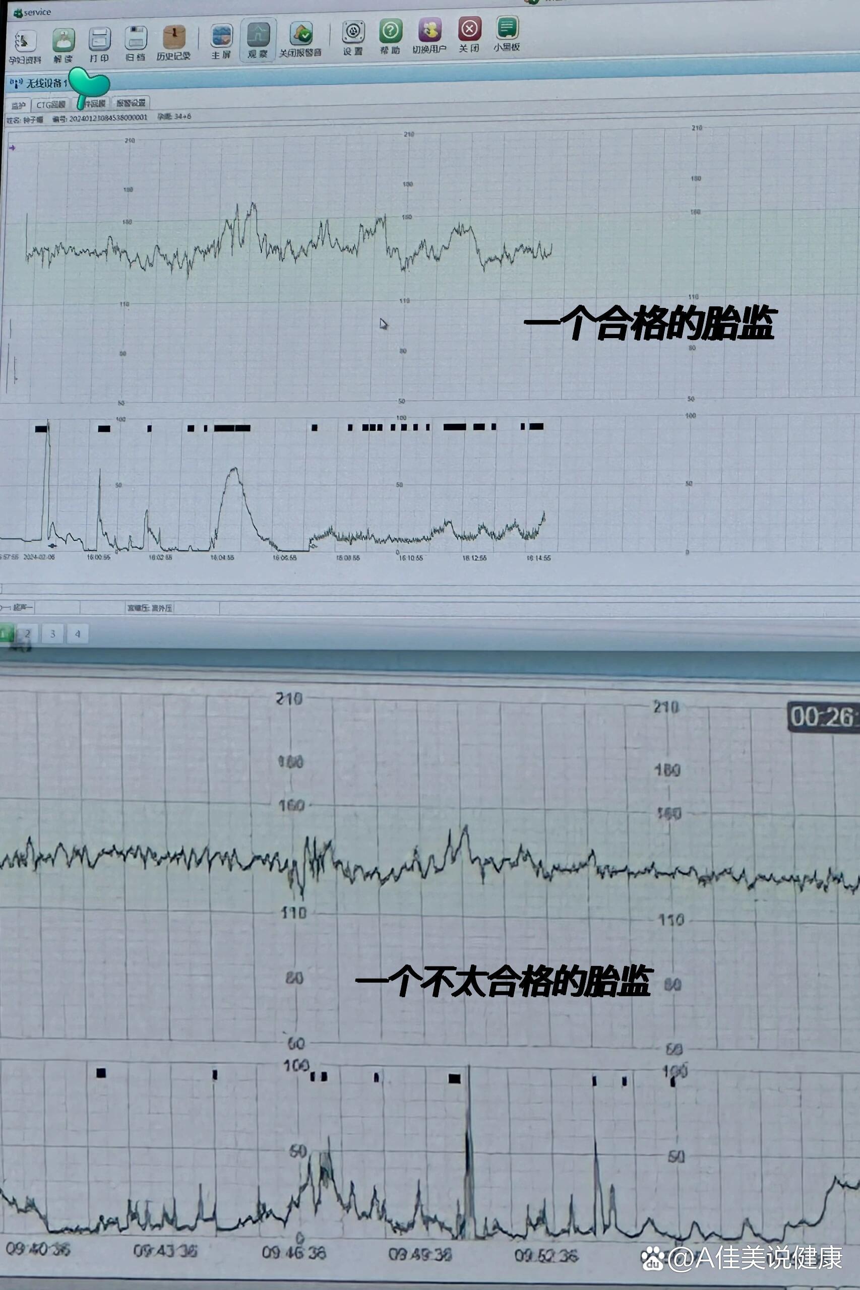 孕晚期的胎心监护总结