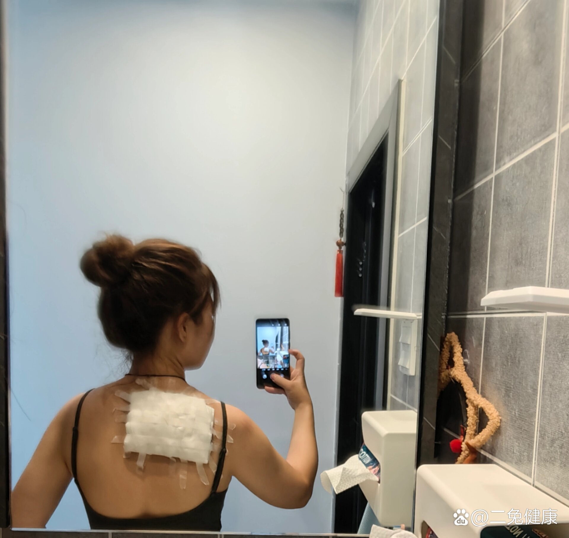 皮脂腺囊肿粉瘤发炎的经历