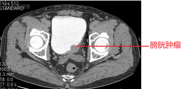 膀胱肿瘤乳头状图片