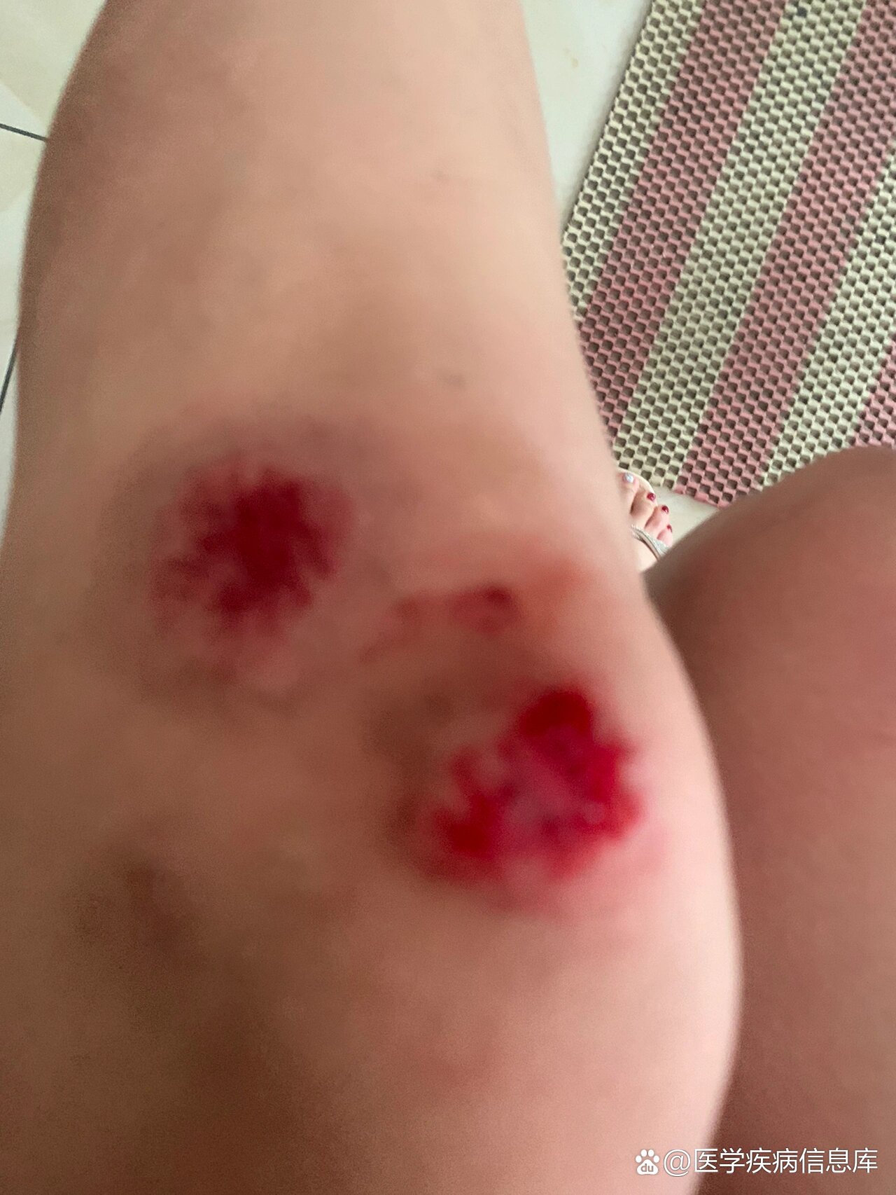 骑电单车摔倒,把手臂,膝盖磕破皮了