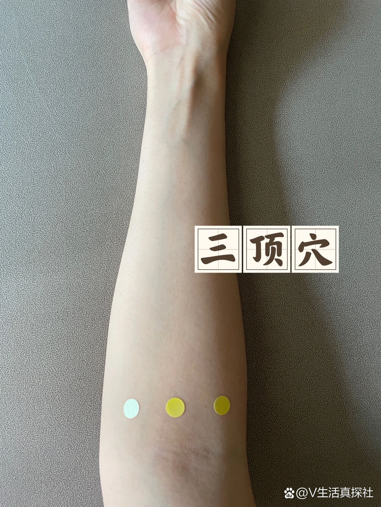 【三顶穴】头顶痛,近视,前额痛