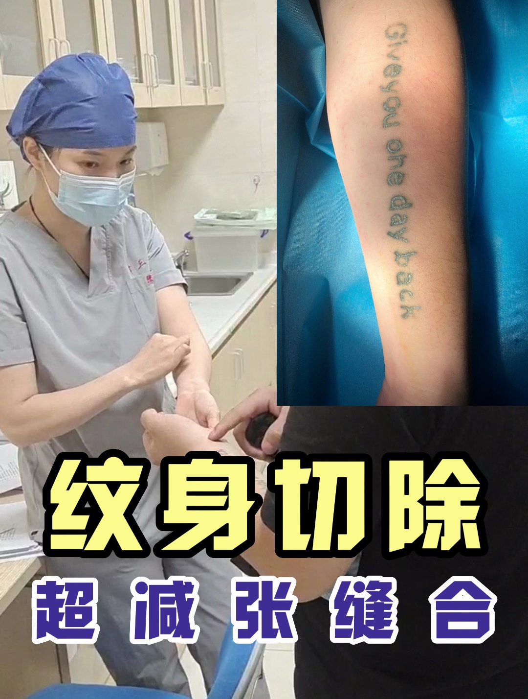 纹身切除,超减张缝合后的样子,前期丑后期美观