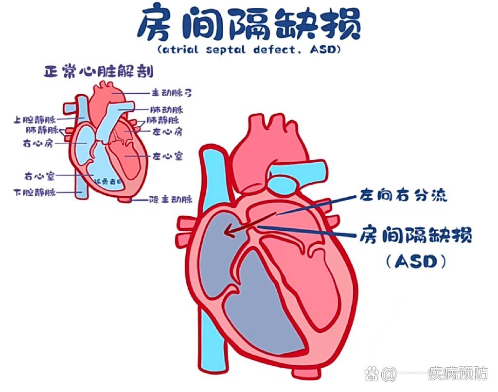 新生儿房间隔缺损图片