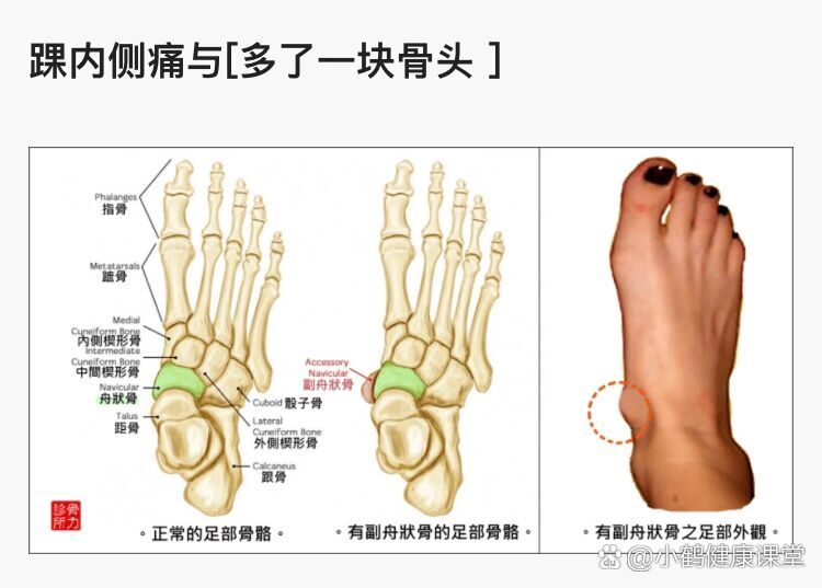 足舟骨在哪个位置图片图片