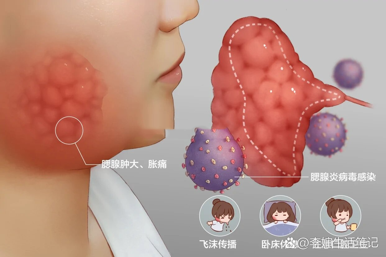  br>主要表现为腮腺肿大,胀痛  br>好发于儿童和青少年,冬春季节高发