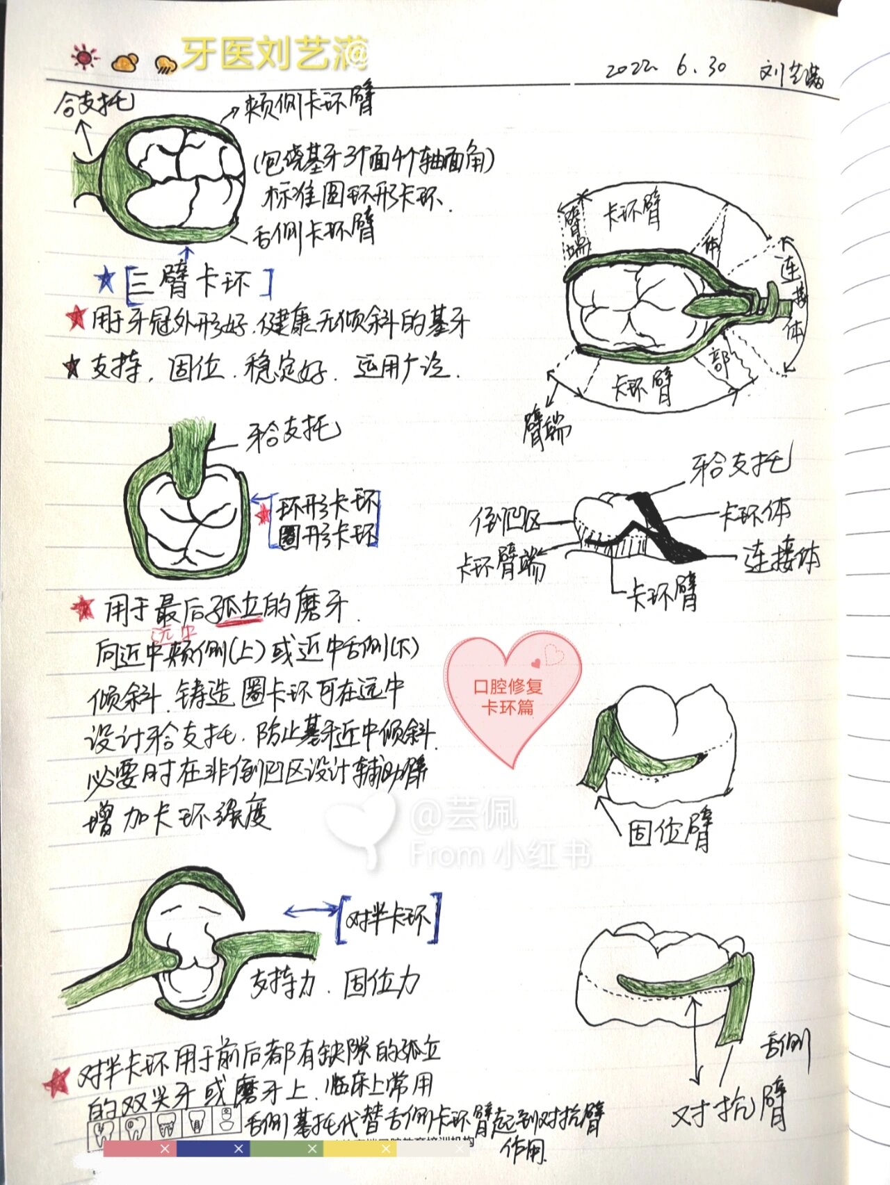 口腔修复笔记卡环篇🦄口腔修复,卡环,其