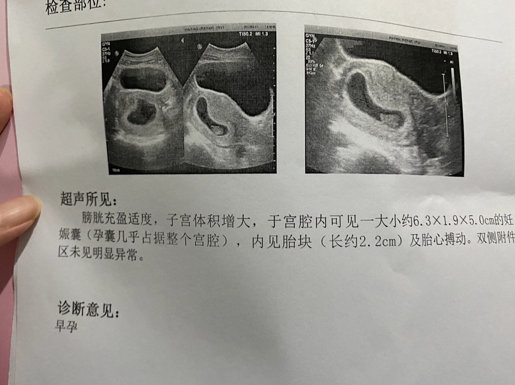 怀孕10周女孩孕囊图图片