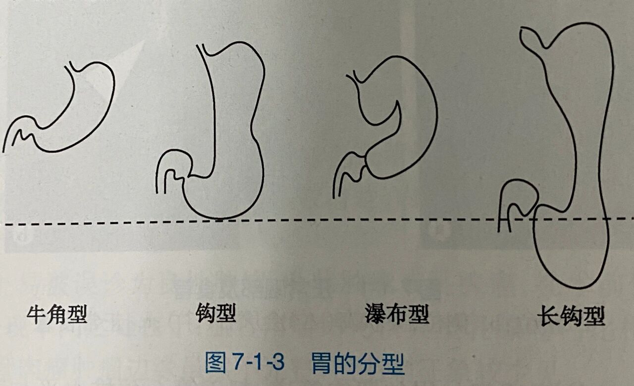 一般可分为以下四种类型 ①牛角型 位置