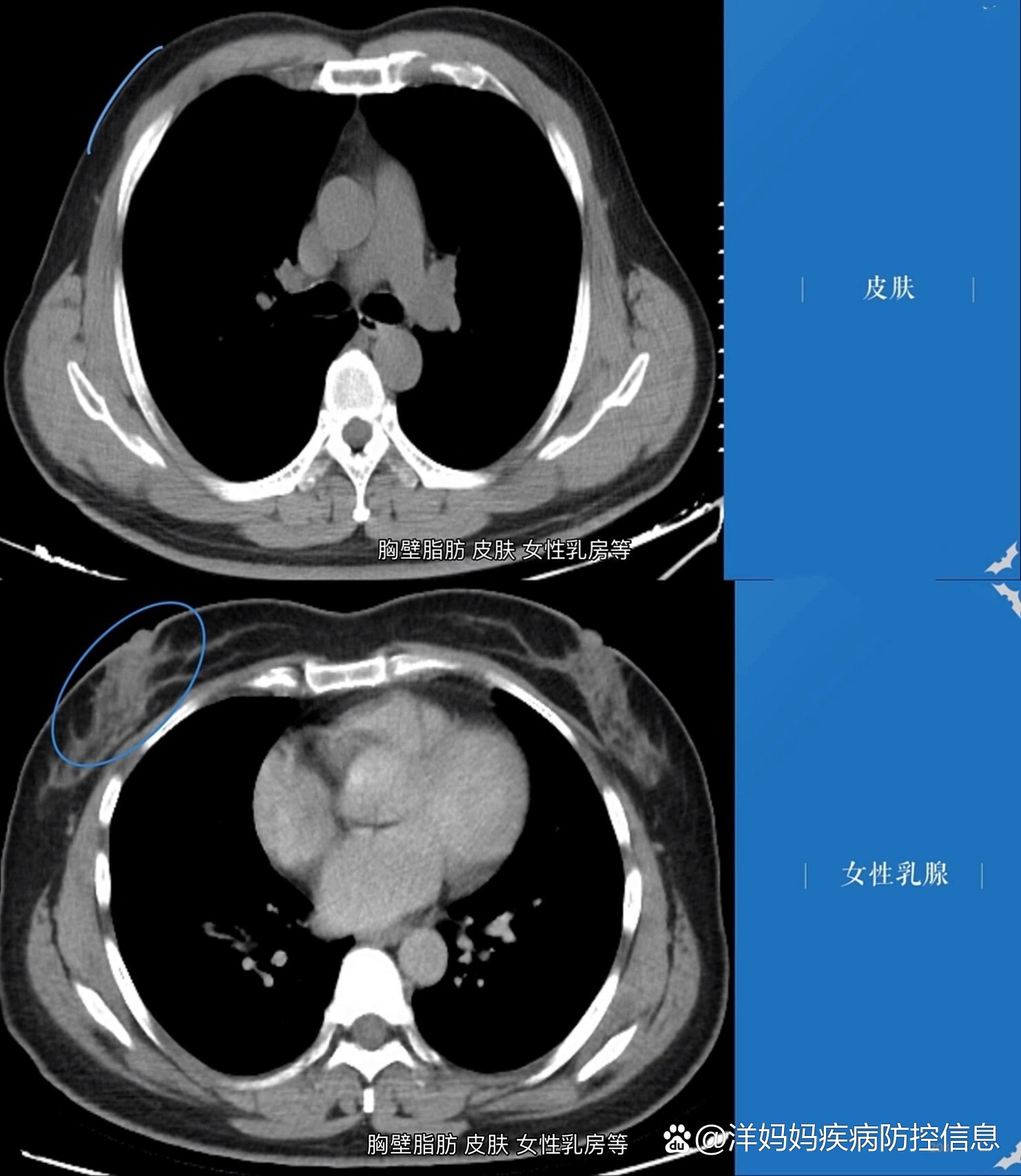 胸部ct正常图像(动脉,心腔…)