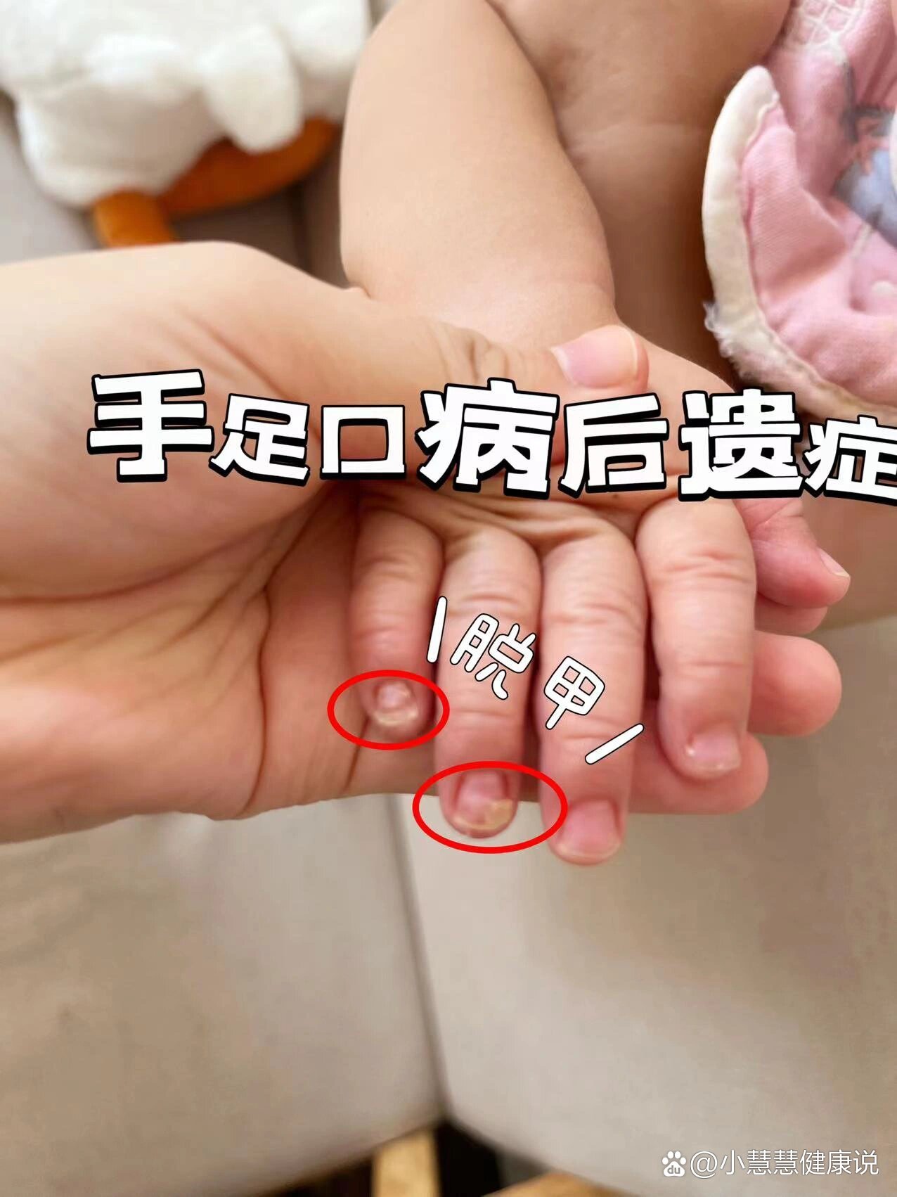 关于手足口病|脱甲|后遗症