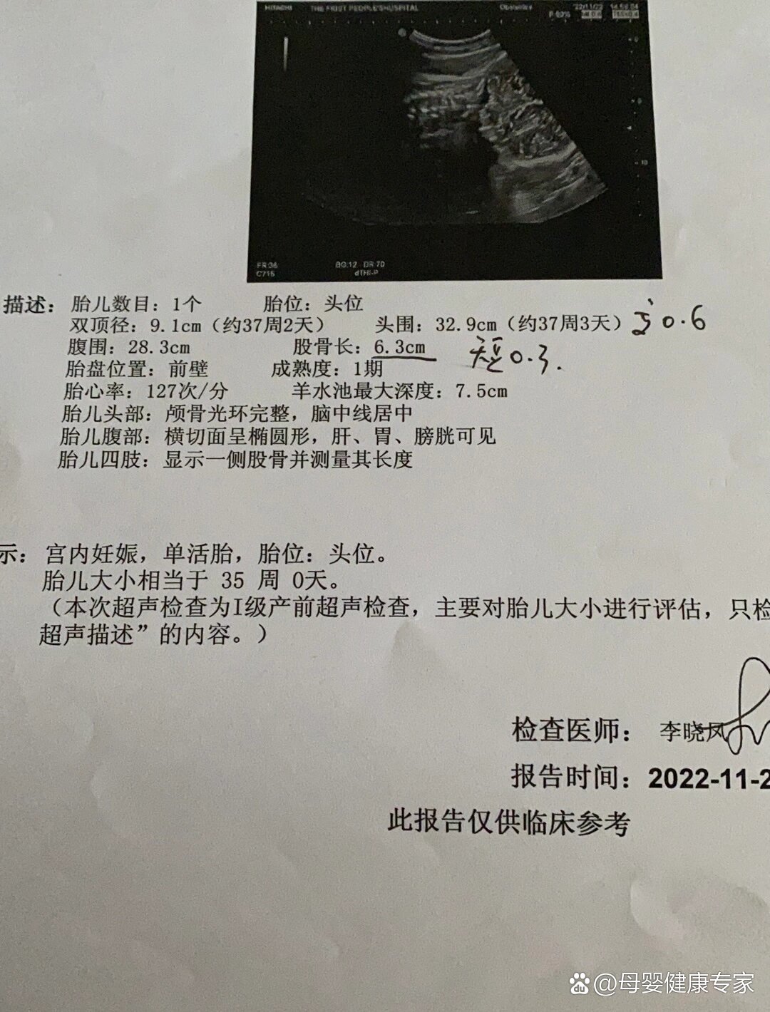 双顶径股骨大于3畸形图片