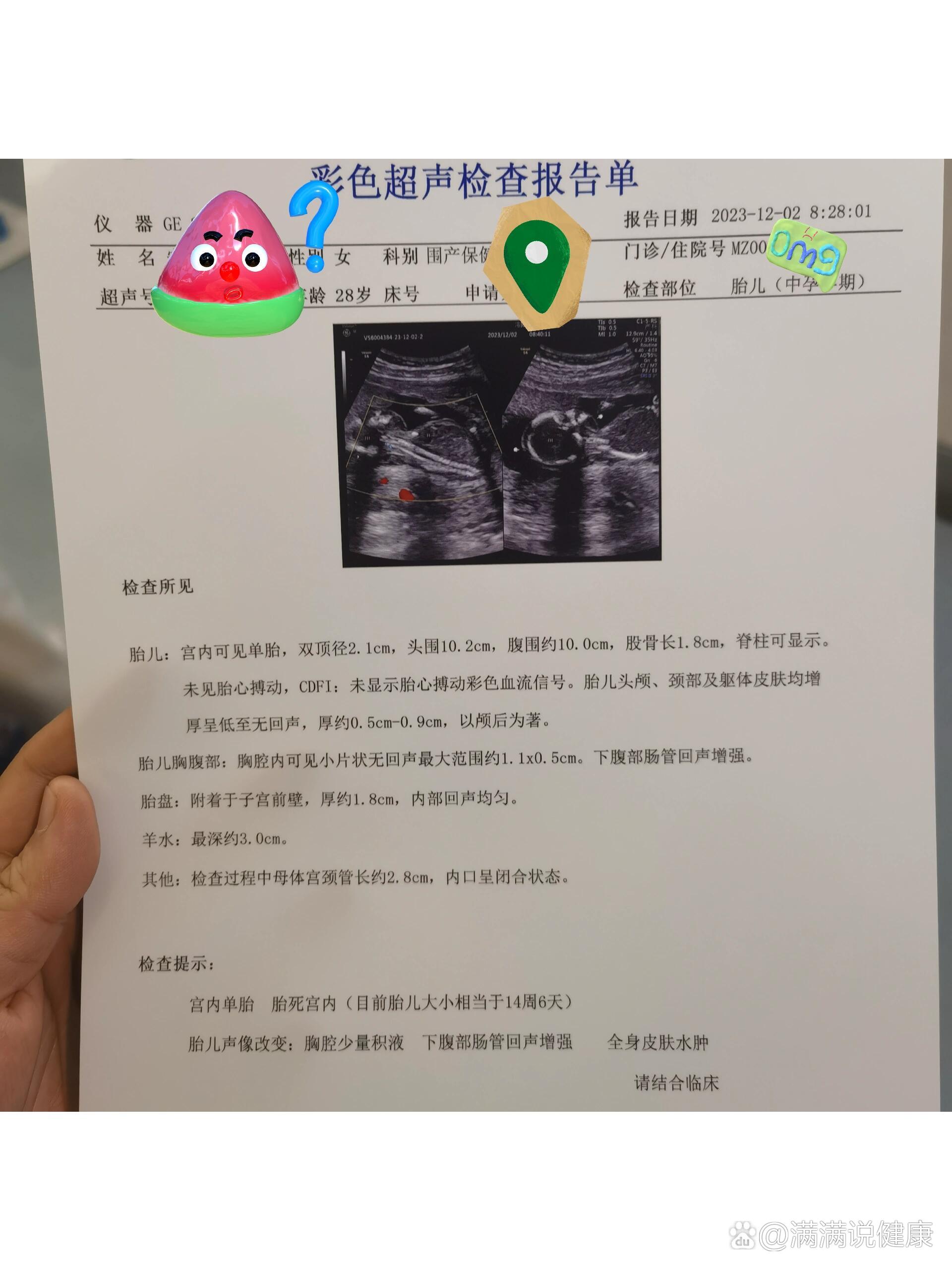 nt检查一切正常,还会胎停吗百科在线