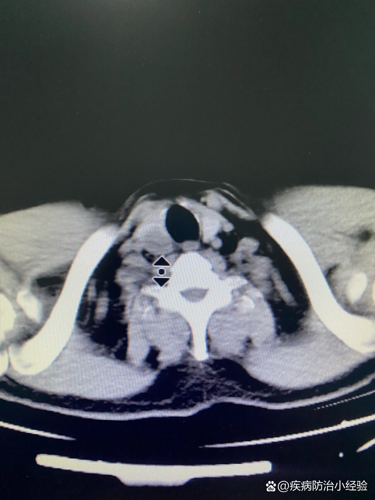 甲状腺右叶低密度影