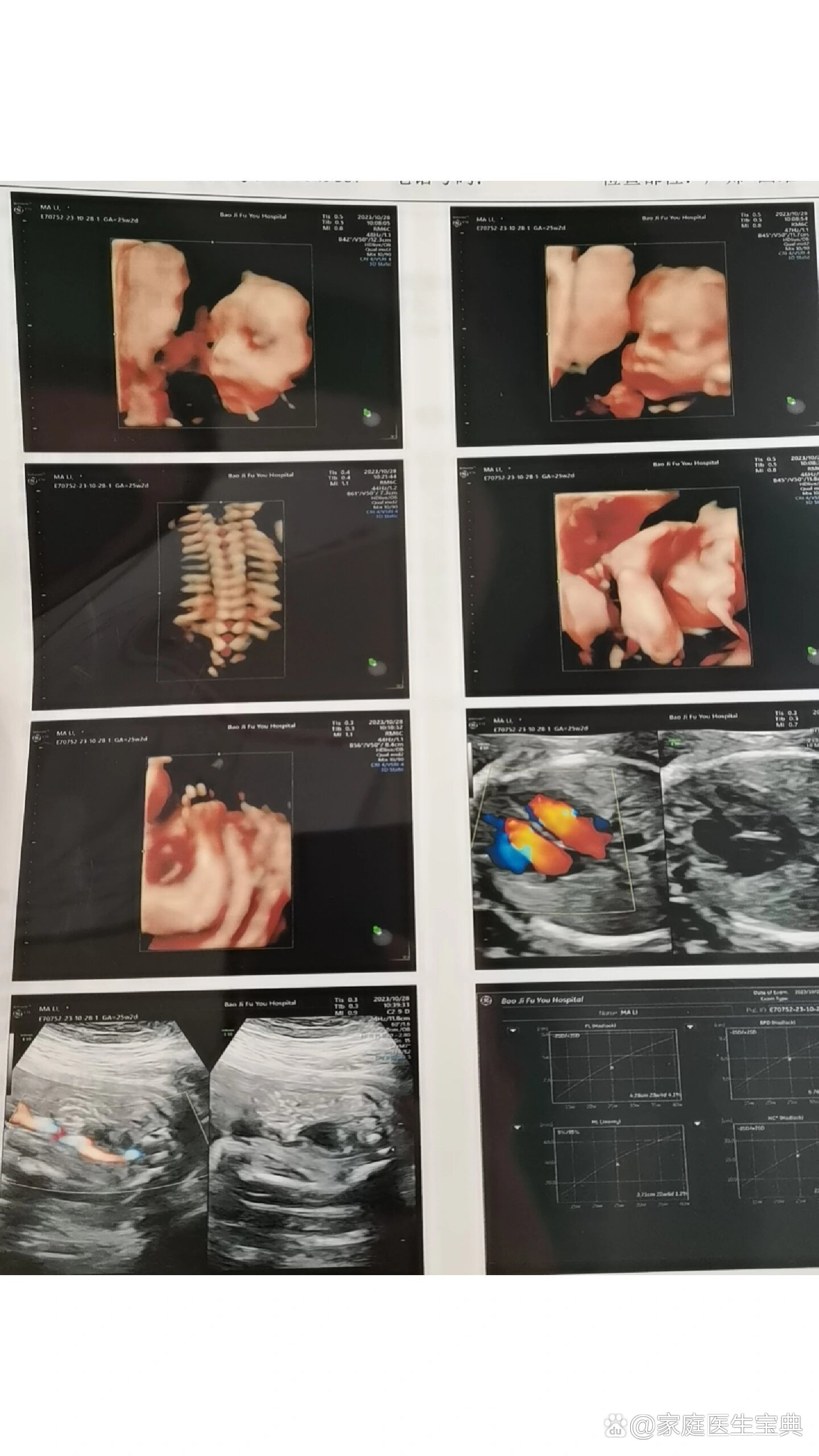 单脐动脉,一定要羊水穿刺吗?